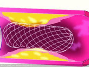 Indias price cap on cardiac stents stifling innovation (c) ET Healthworld